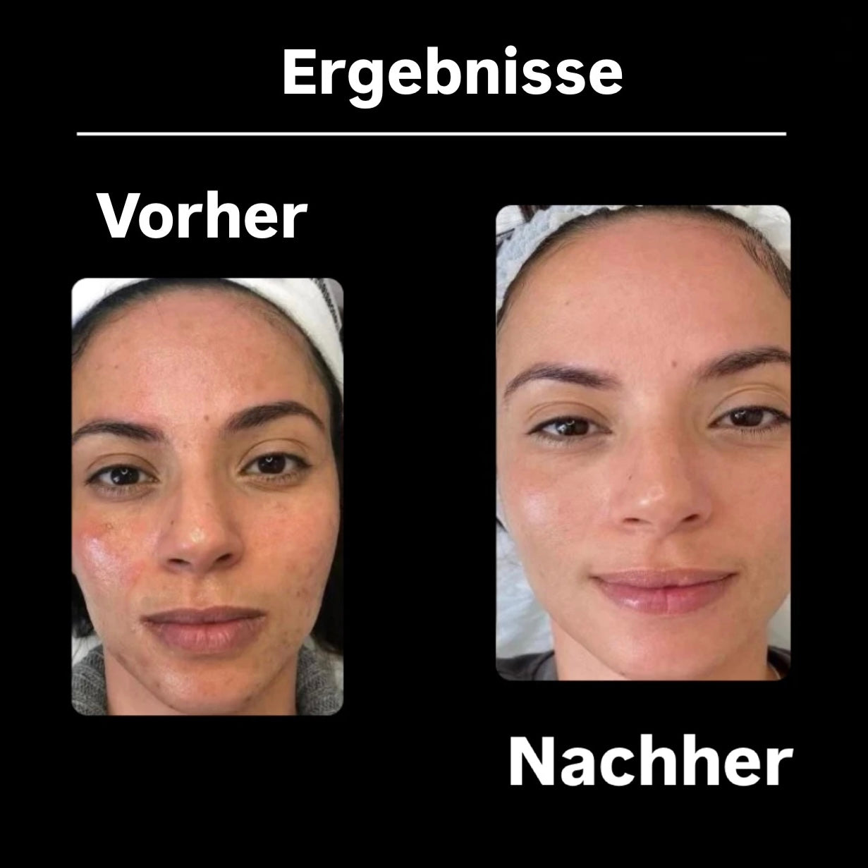 DERMATOOL | Ihr All-in-One-Tool für die perfekte Hautpflege!